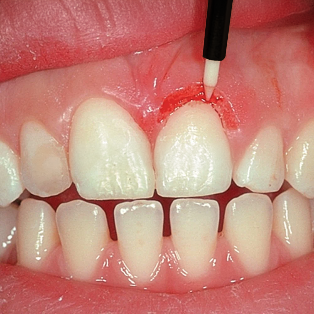 ASİDENTDENTAL STUDİO6360Zirconia TISSUE TRIMMER KIT (6ea) ZİRKON DİŞ ETİ FREZİ SETİ