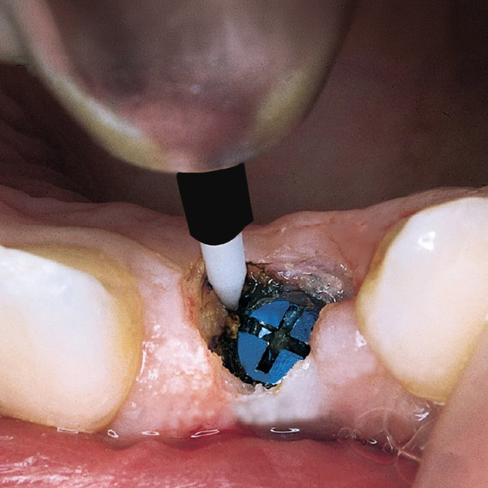 ASİDENTDENTAL STUDİO6361TISSUE TRIMMER (Short) DİŞ ETİ KESİM FREZİ ZİRKON KISA
