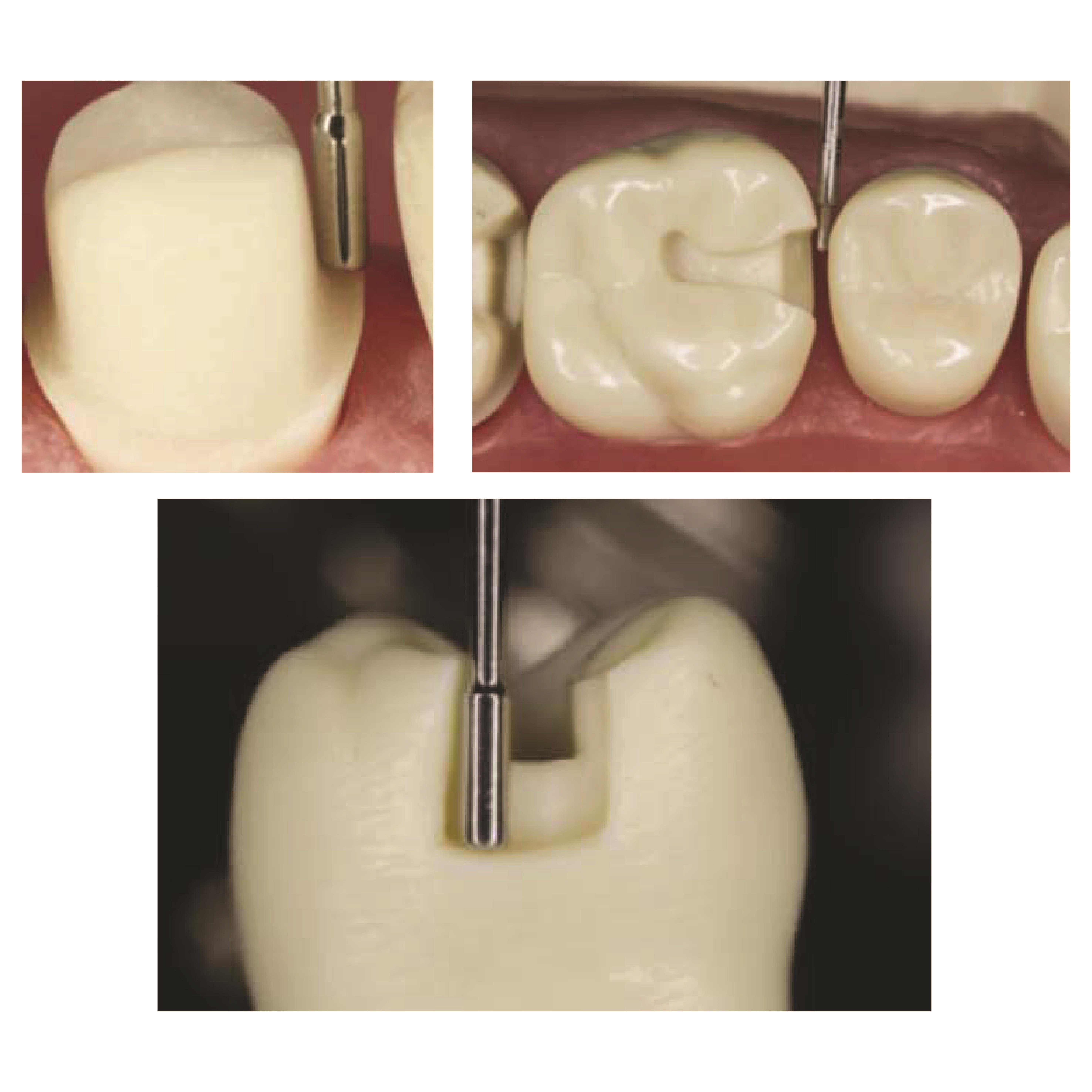 ASİDENTOSUNGMIVD-02MIVD-02 KAVİTE VE BOY ÖLÇME EL ALETİ 1MM*2,5MM-1,5MM*4 MM