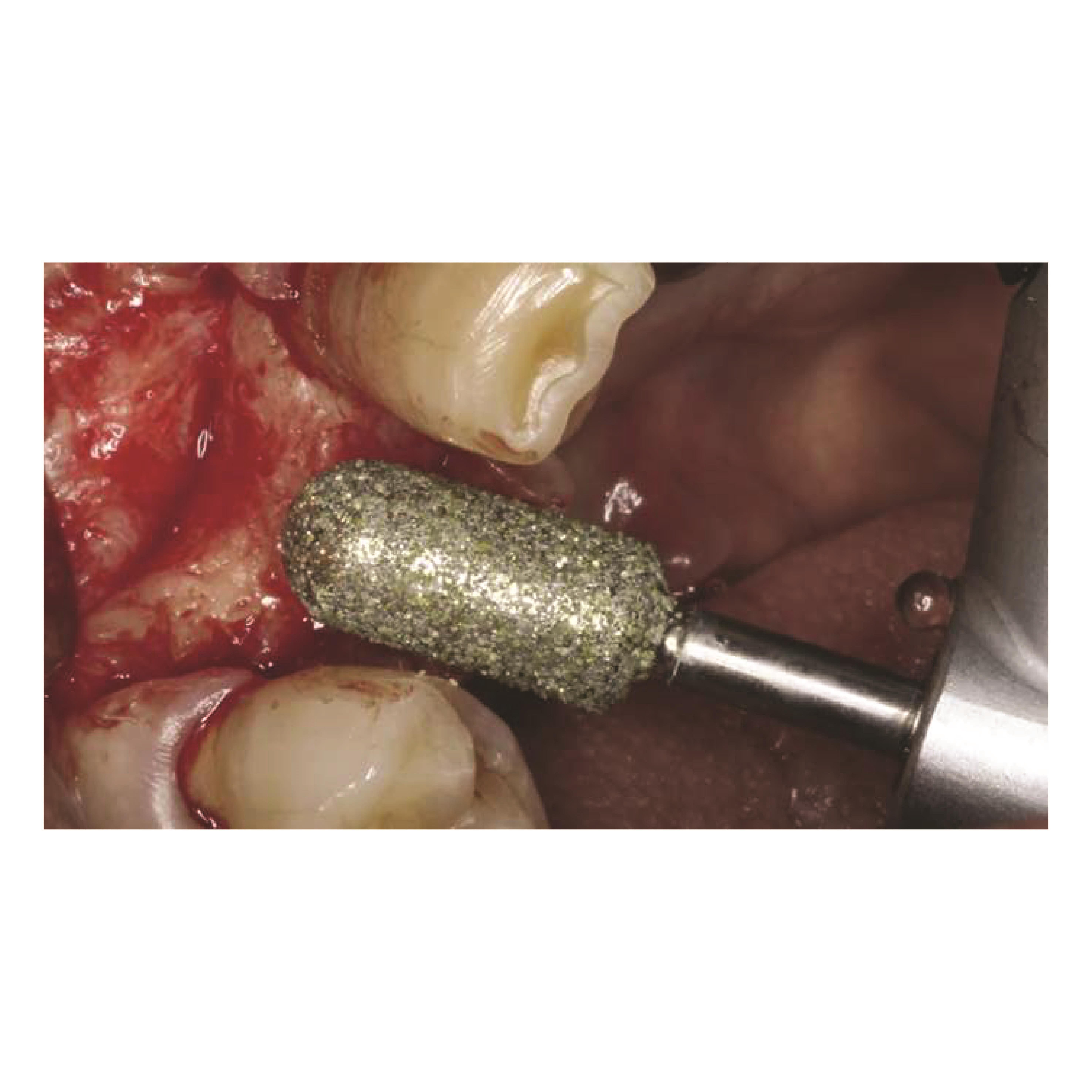 ASİDENTOSUNGNBRBEC50NBRBEC50 Narrow Bone Removing Bur CERRAHİ KEMİK DÜZELTME FREZİ ELMAS ANGULDURUVA İÇİN
