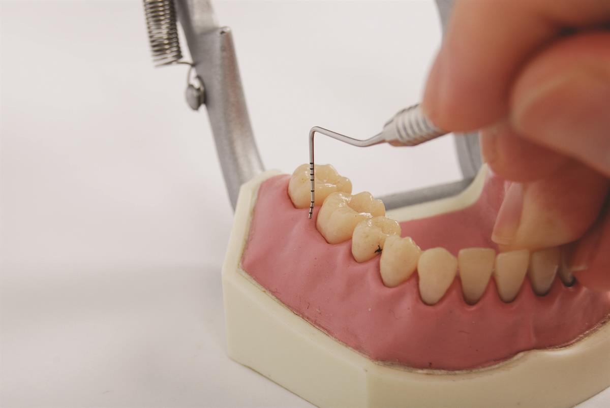 ASİDENTOSUNG(BPW15)(BPW15) Probe PERİODENTAL SOND