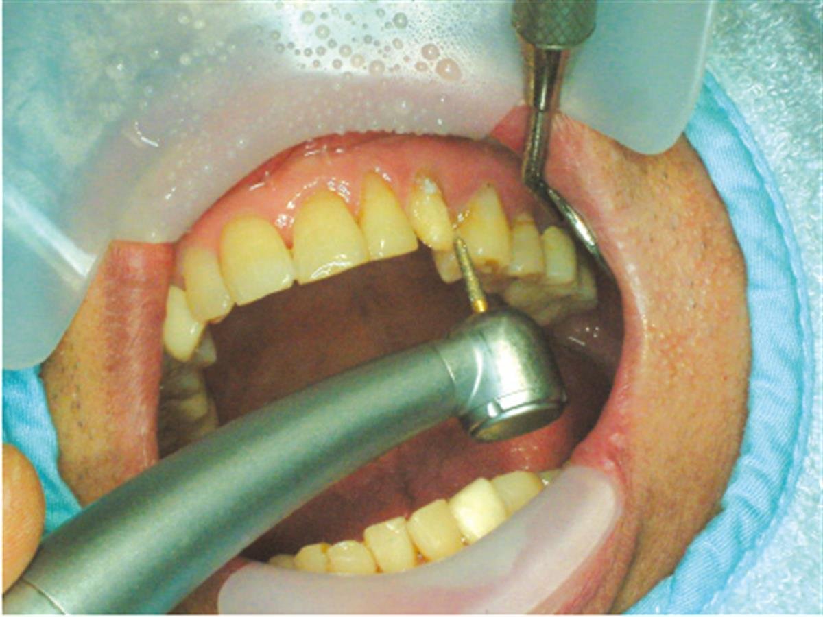 ASİDENTOSUNG(RTLAS)(RTLAS) Retractor