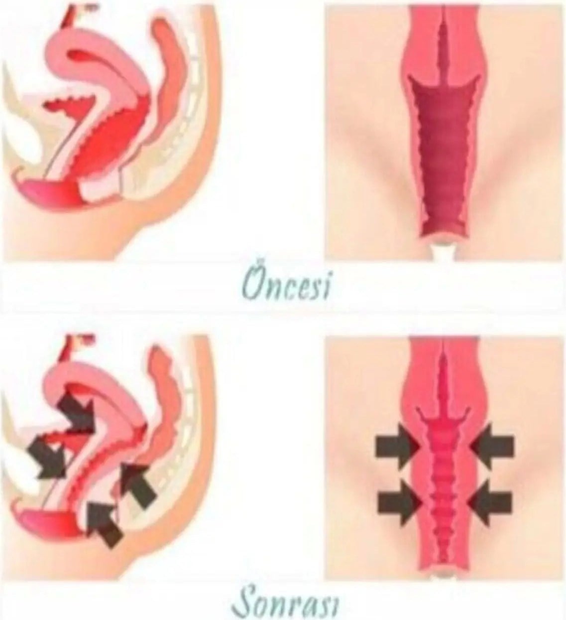 Süper Vagitight Kadınlar Için Genital Bölge Krem 100 ml x 2 Adet
