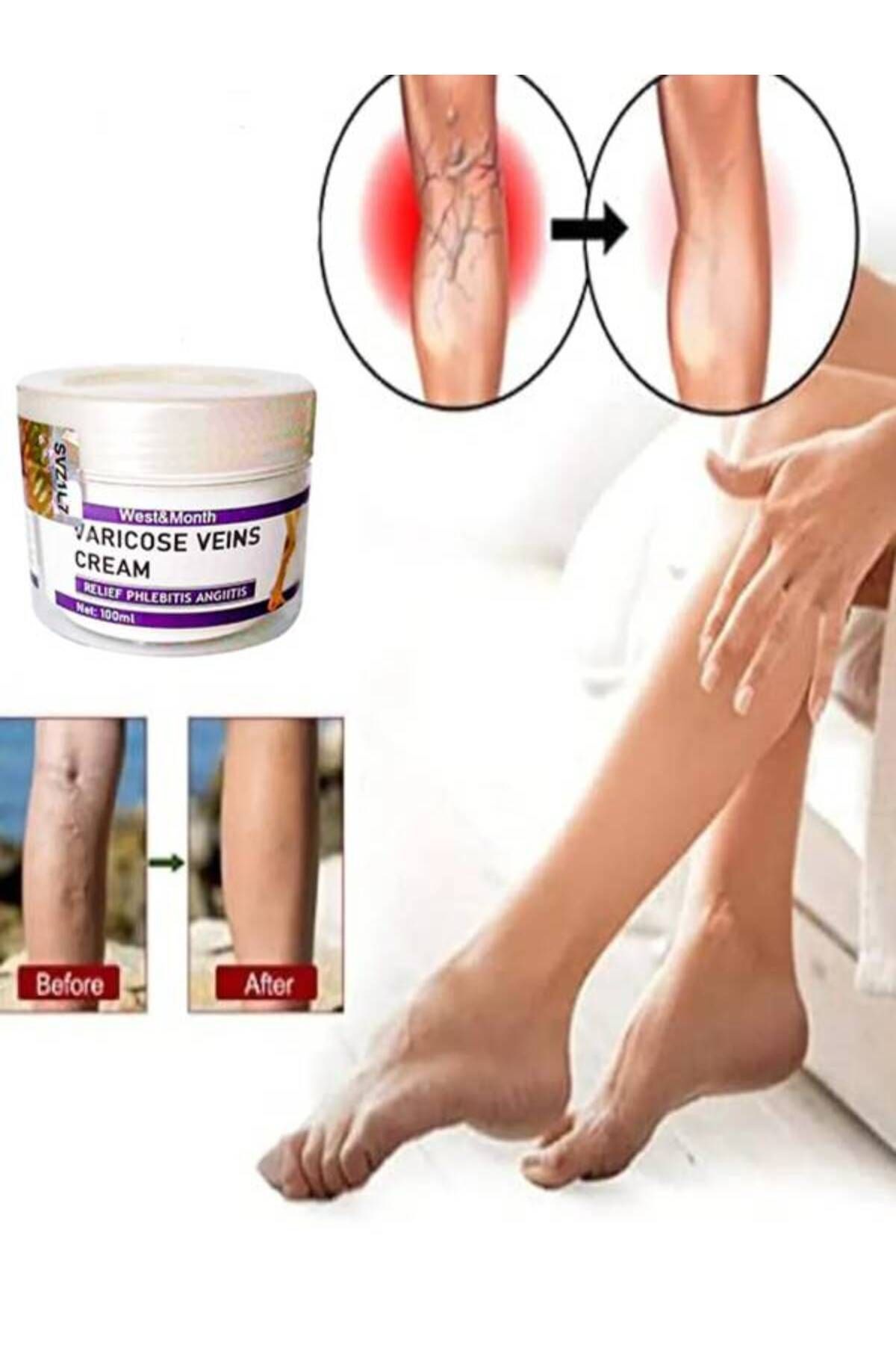 West & Month Varicose Vein Var.is Karşıtı Masaj Bakım Kremi 100 ml