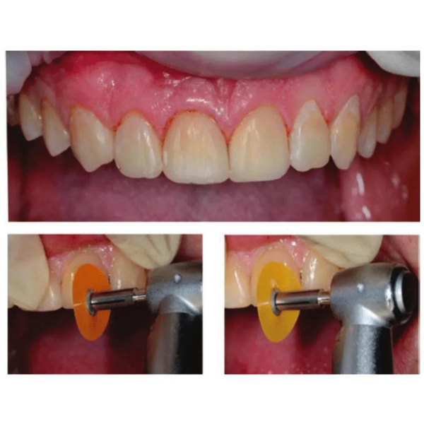 3M ESPE SOFT LEX İnce Bitirme  ve Cila Disk Seti 240'lık