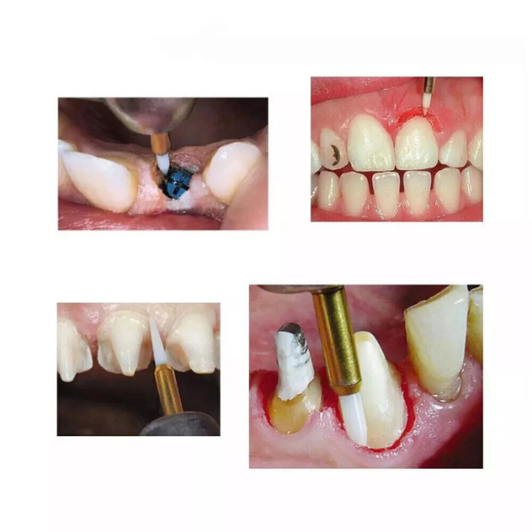 Cerrahi Yumuşak Doku Firezi -Zirkonyum Diş Eti Hassas Kesim Firezi 2'li Pkt.