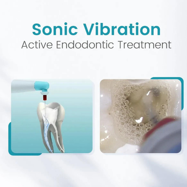 G-Force Sonic Endo Aktivatör İrigasyon Cihazı (60 Yedek Uç Ücretsiz)