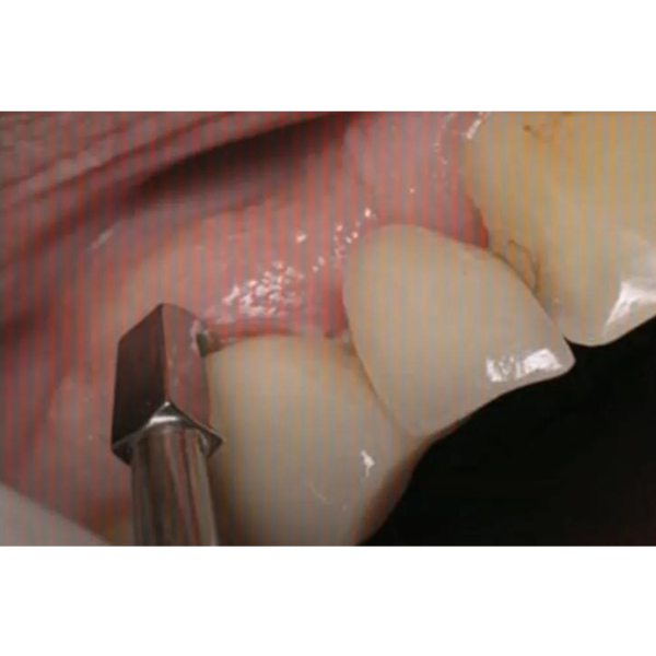 Otomatik Kron Sökücü