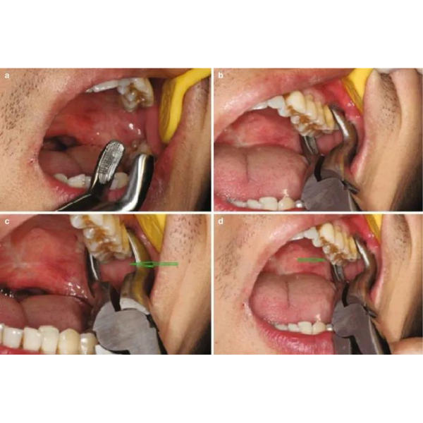 Perfect Üst Kök Davyesi Fig.51 A