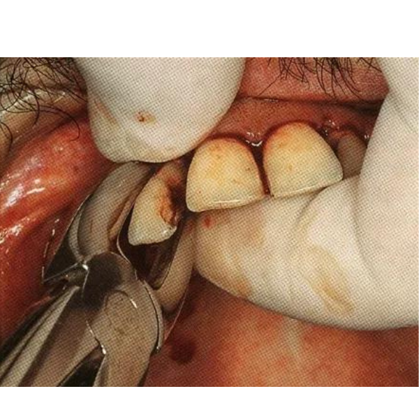 Perfect Üst Kök Küçük Azı Davyesi Fig 18 