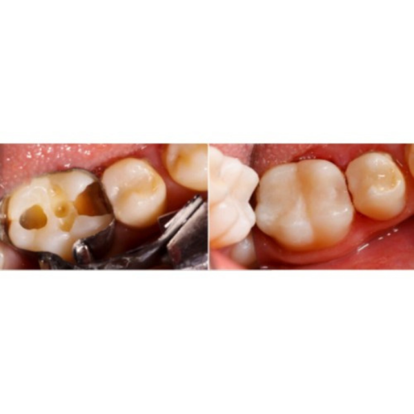 Wega Dent W-Com N Nano Kompozit Tek Tüp