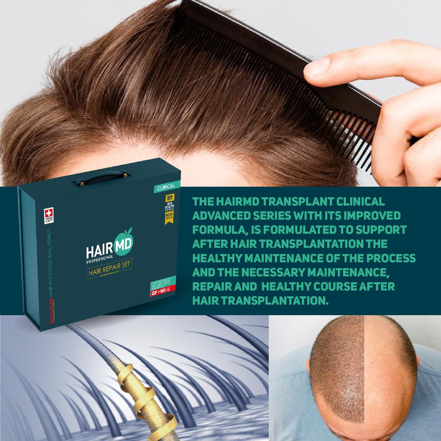 Hairmd Clinical Advanced Hair Repair Set 4 Months Use Bond Bag (4 Shampoo 100 Ml  + 3 Serum 60 ml + 3 Tablet + 5 Flakon Meso Serum  + Dermaroller Set )