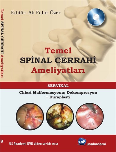 Temel Spinal Cerrahi Ameliyatları  Chiarimalformasyonu; dekompresyon + duraplasti