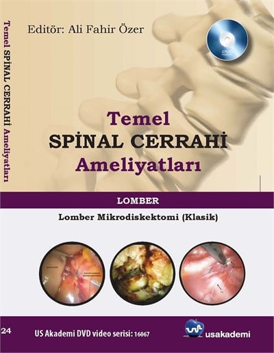 Temel Spinal Cerrahi Ameliyatları  Lomber mikrodiskektomi (klasik)