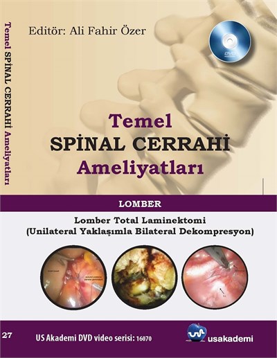 Temel Spinal Cerrahi Ameliyatları  Lomber total laminektomi (unilateral yaklaşımla bilateral dekompresyon)