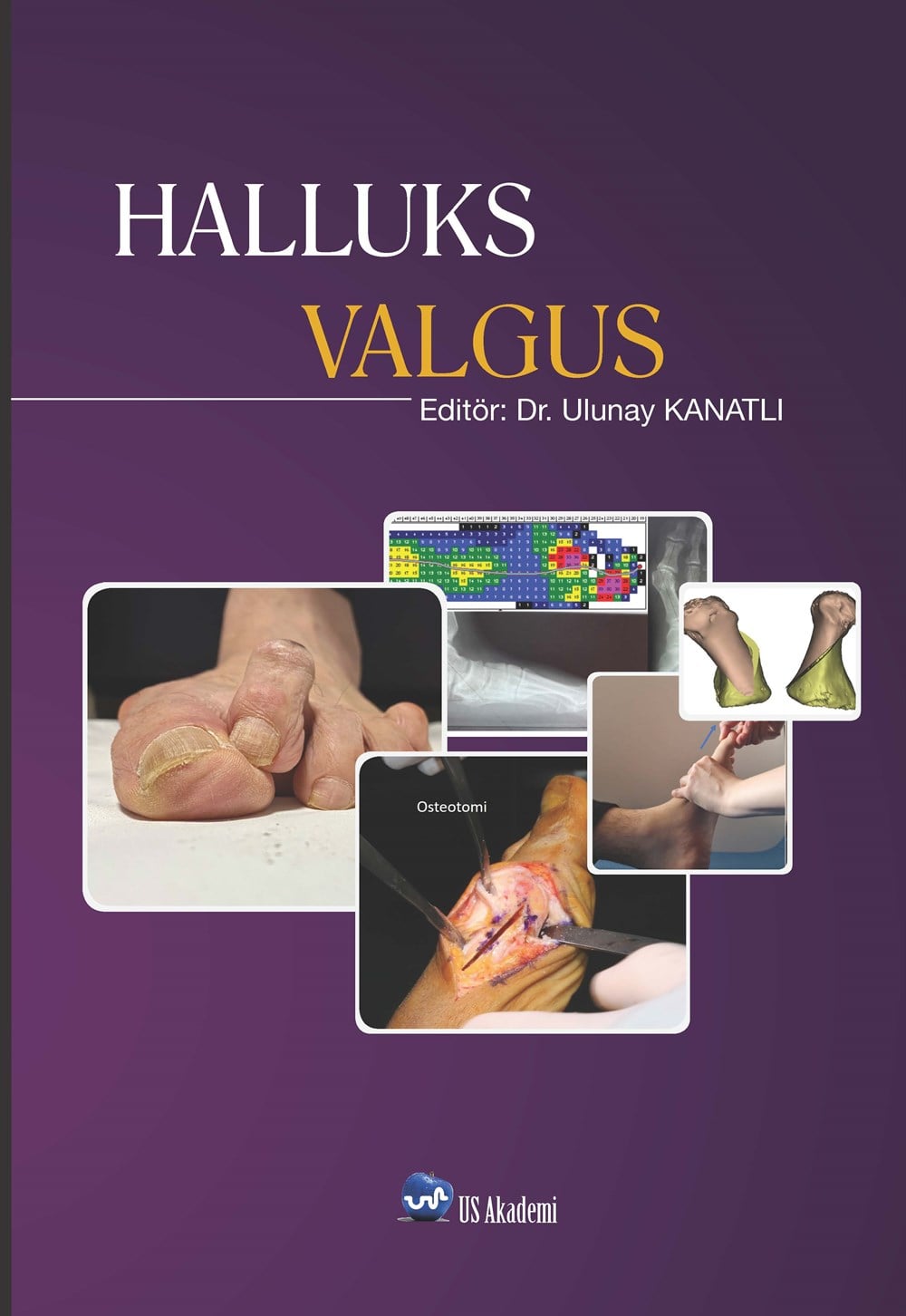 HALLUKS VALGUS