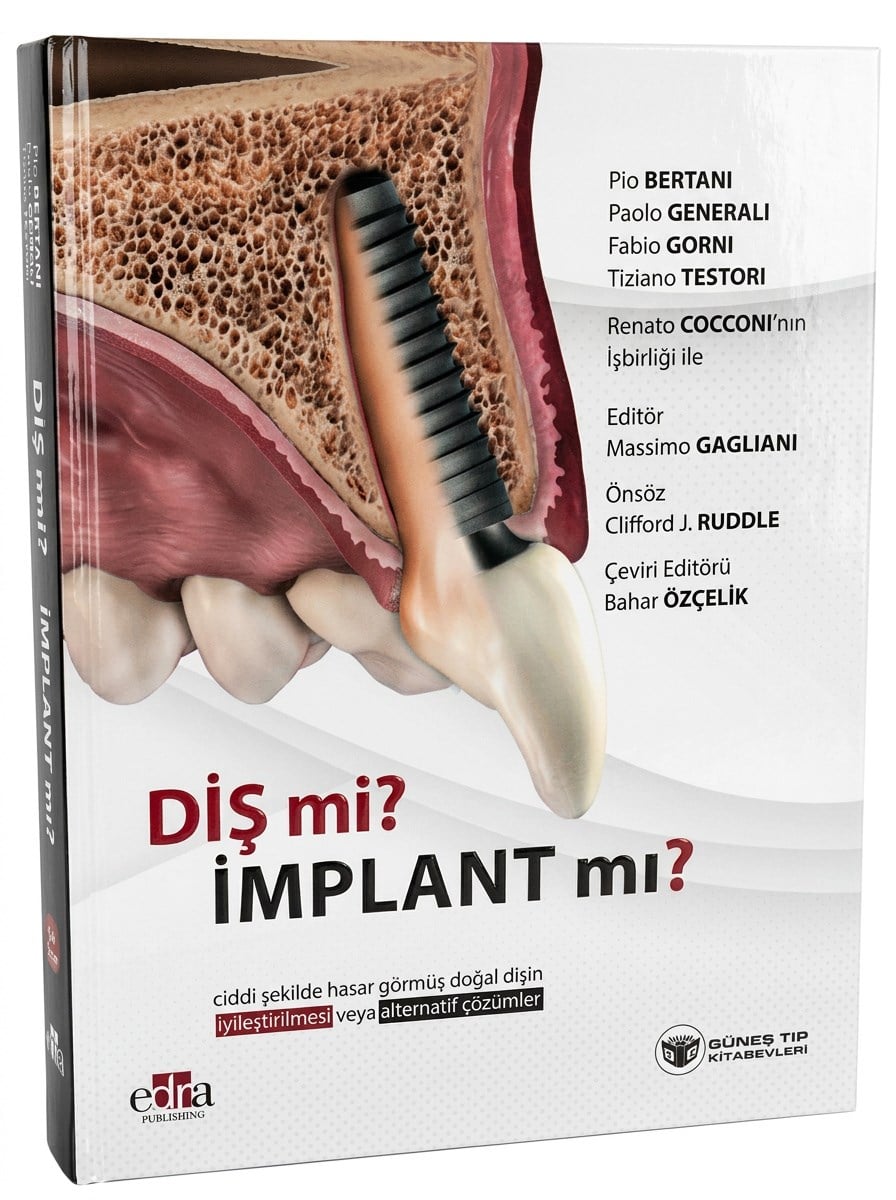 Diş mi? İmplant mı? (Doğal Dişin Korunması veya İmplant Çözümleri Üzerine Kapsamlı Rehber)