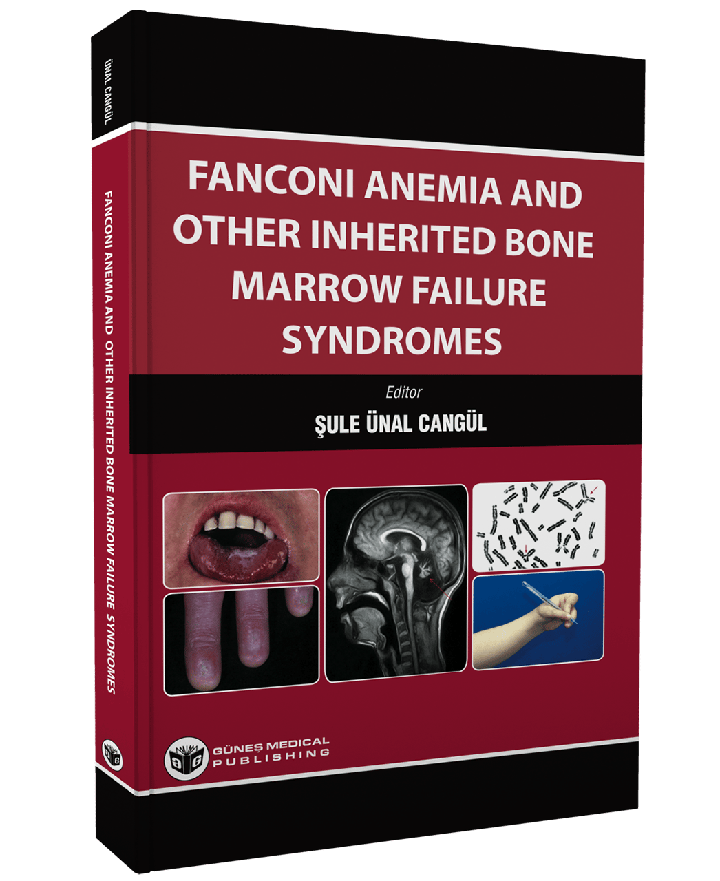 Fanconi Anemia And Other Inherited Bone Marrow Failure Syndromes