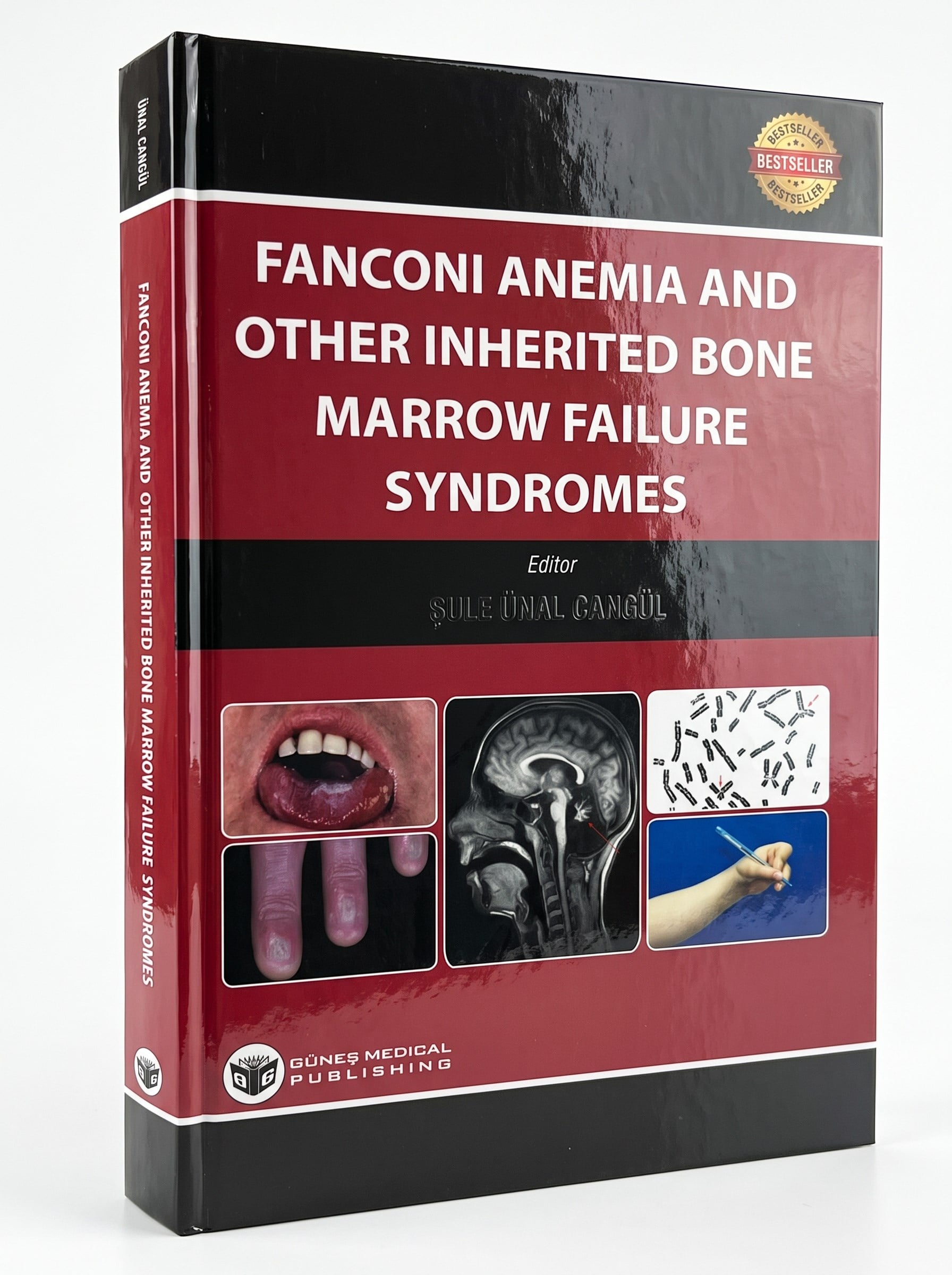 Fanconi Anemia And Other Inherited Bone Marrow Failure Syndromes