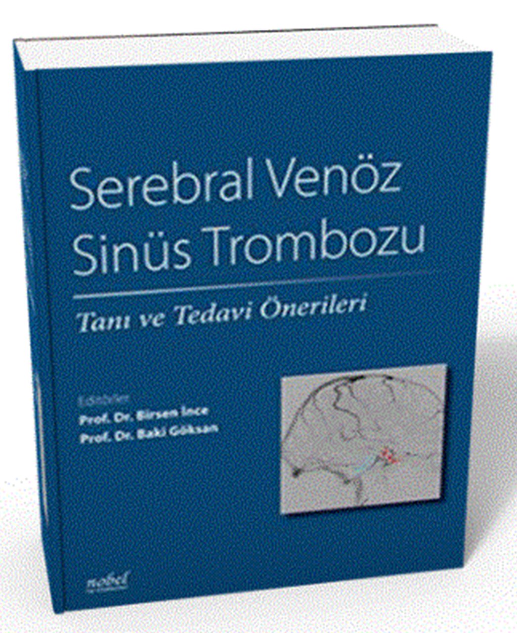 Serebral Venöz Sinüs Trombozu: Tanı ve Tedavi Önerileri