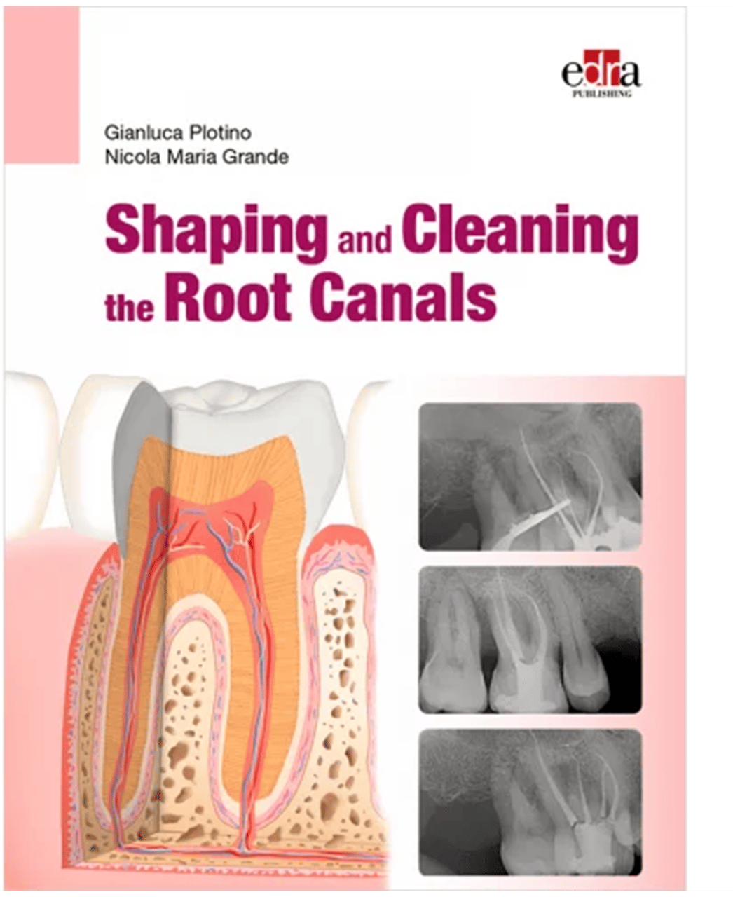 Shaping and Cleaning the Root Canals
