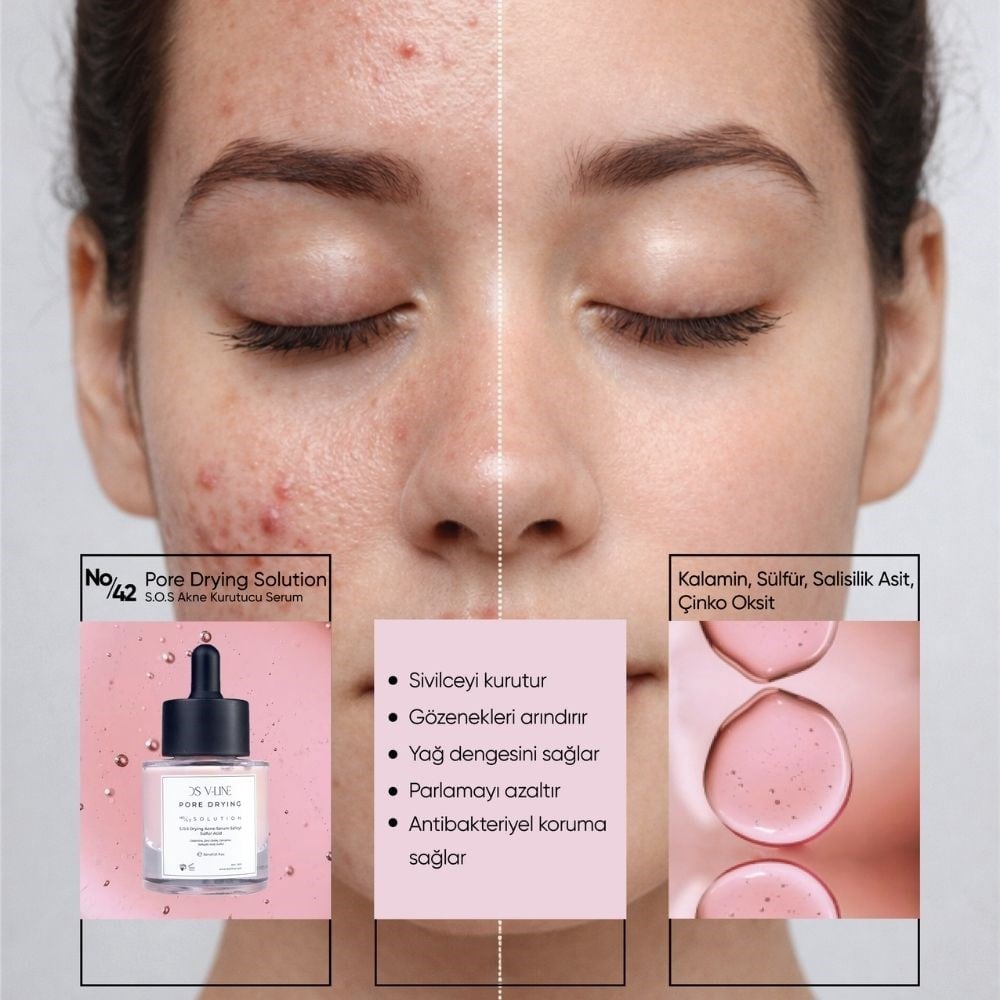 S.O.S Sebum Dengeleyici Serum