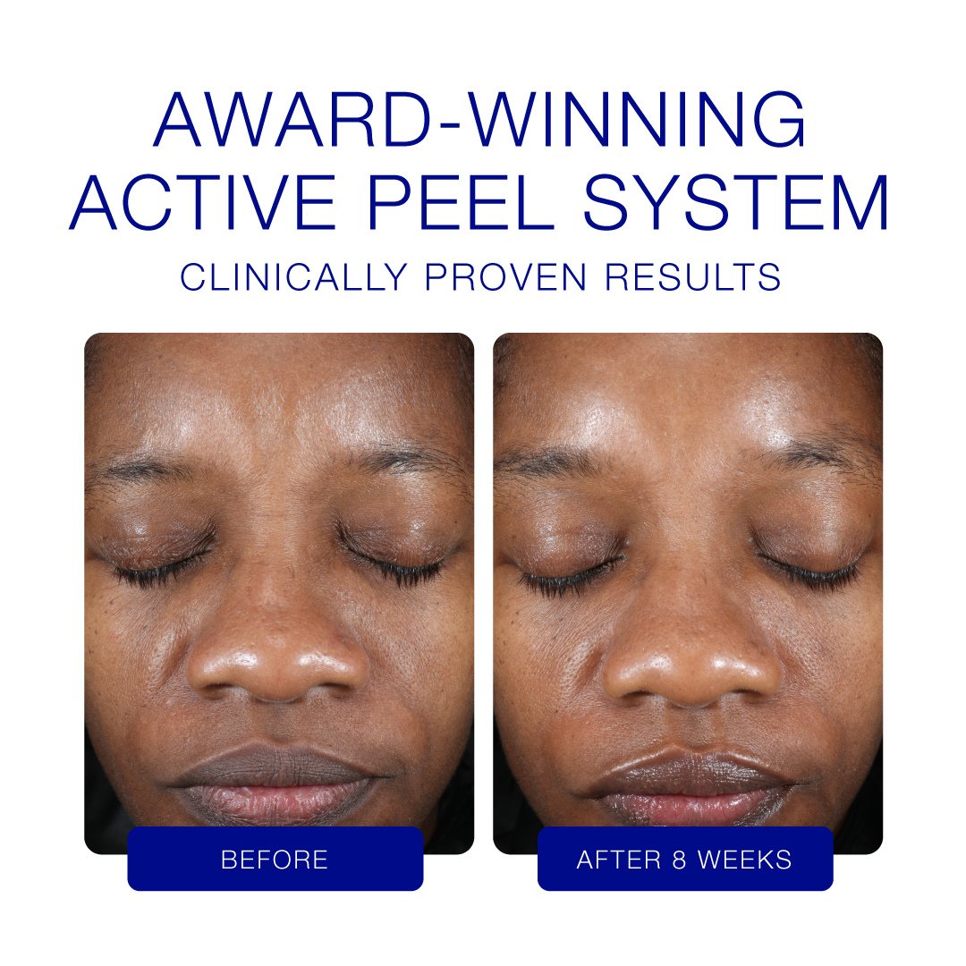 PeelingiS Clinical Active Peel System