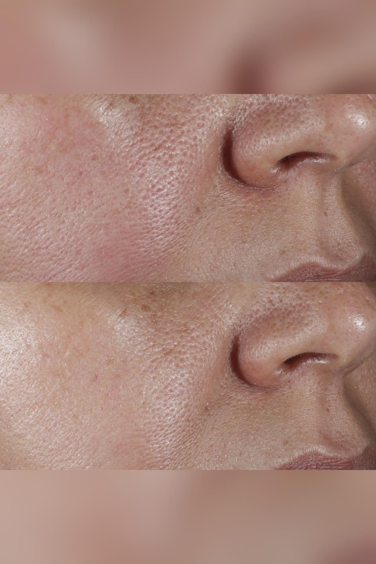 Perricone MD Gözenek Sıkılaştırıcı Yüz Toniği 118ML