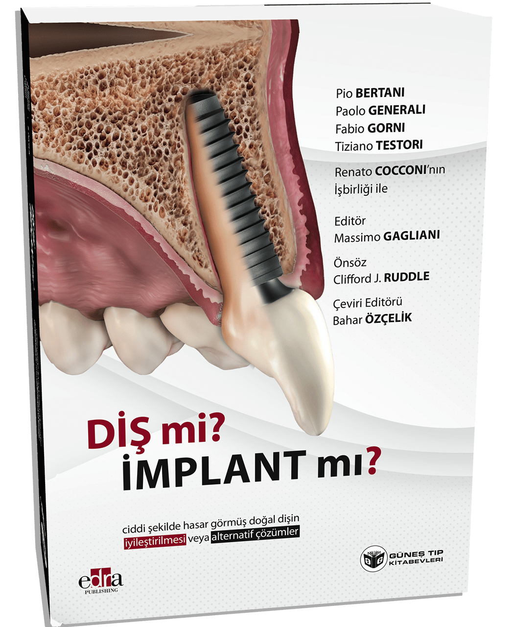 Diş mi? İmplant mı? (Doğal Dişin Korunması veya İmplant Çözümleri Üzerine Kapsamlı Rehber)