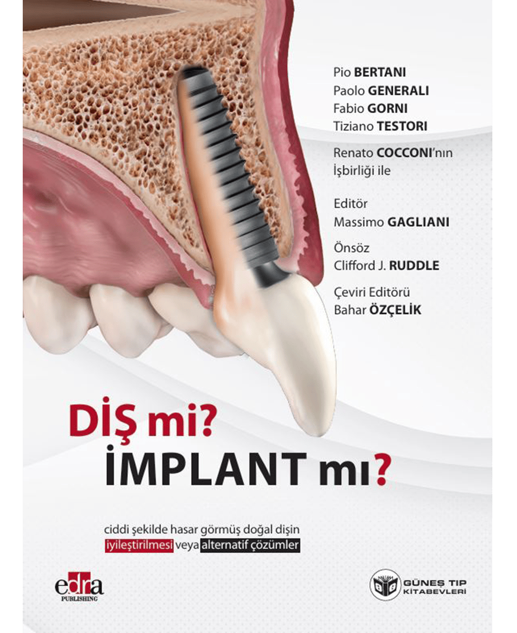Diş mi? İmplant mı? (Doğal Dişin Korunması veya İmplant Çözümleri Üzerine Kapsamlı Rehber)