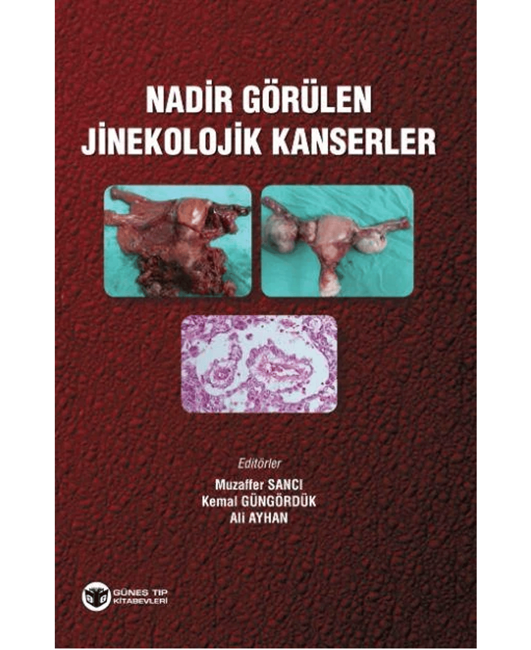Nadir Görülen Jinekolojik Kanserler