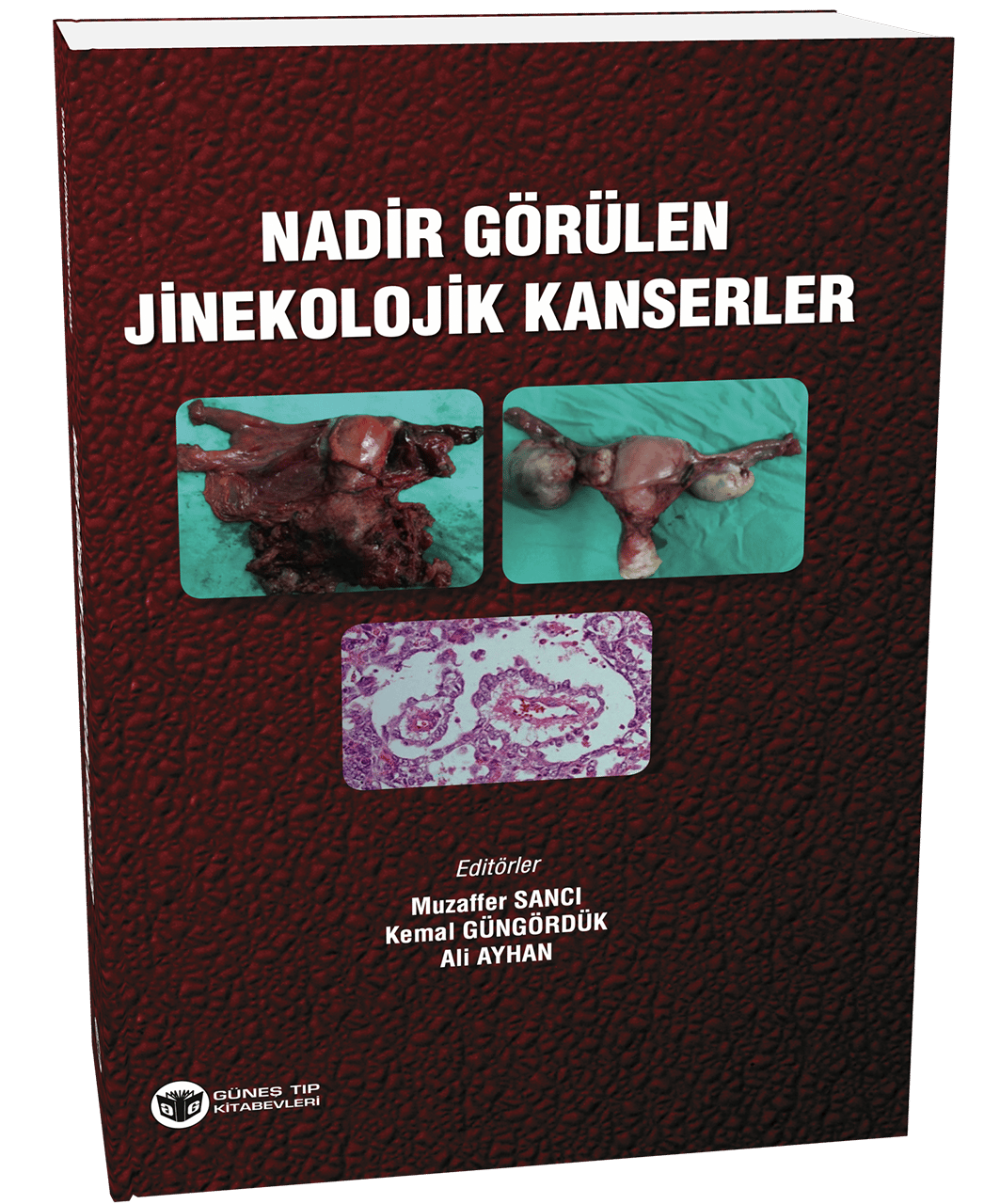 Nadir Görülen Jinekolojik Kanserler