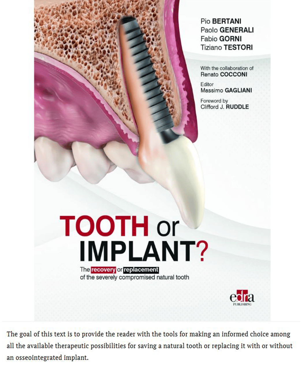 Tooth or Implant