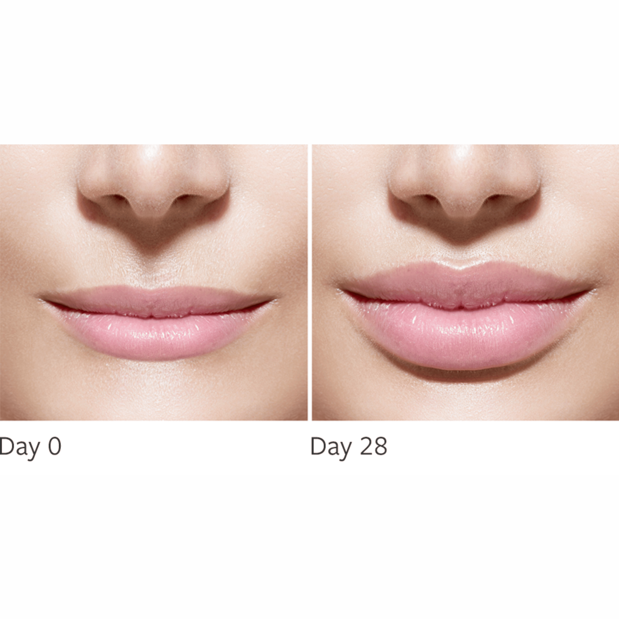 LIP INJECTION