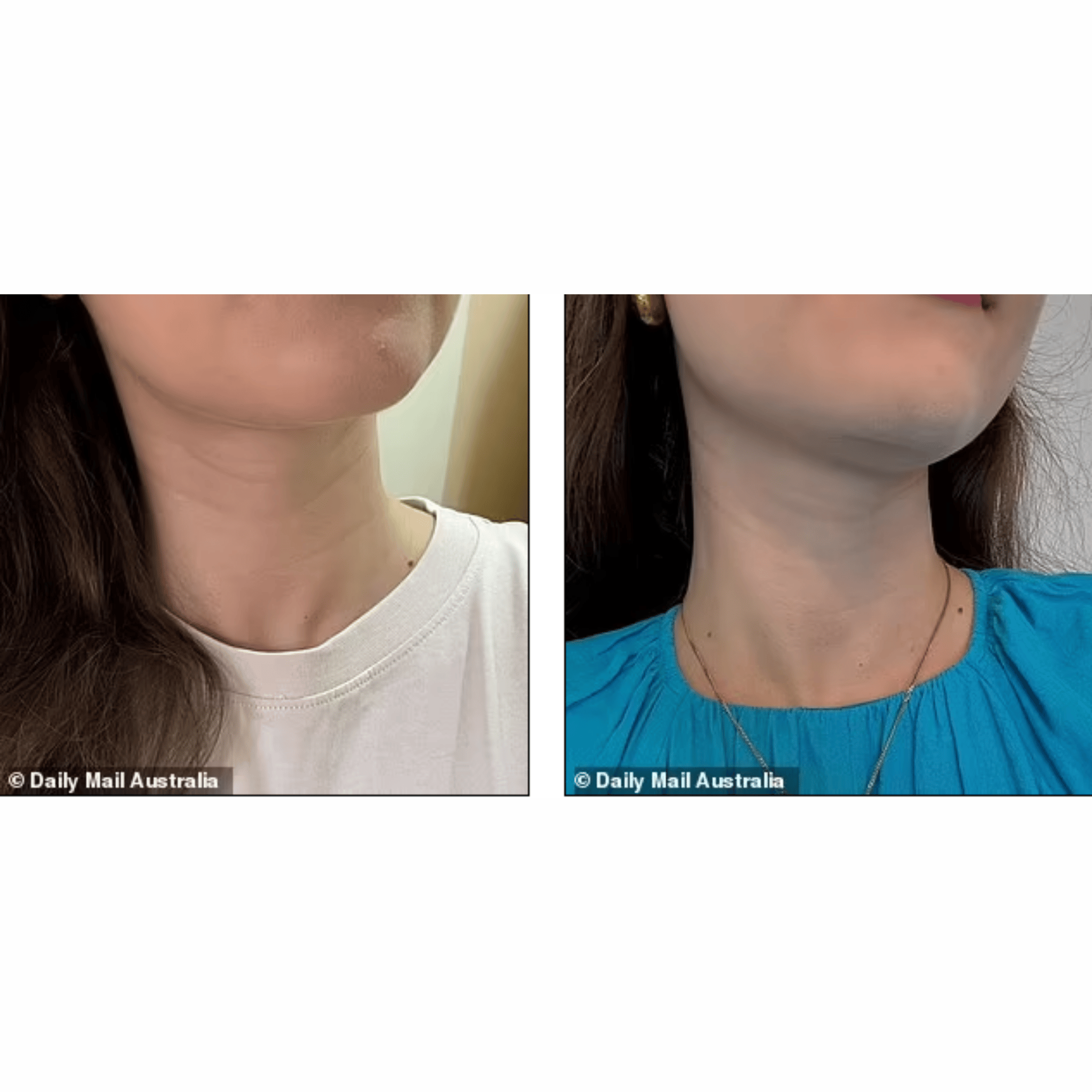 NECK LIFT