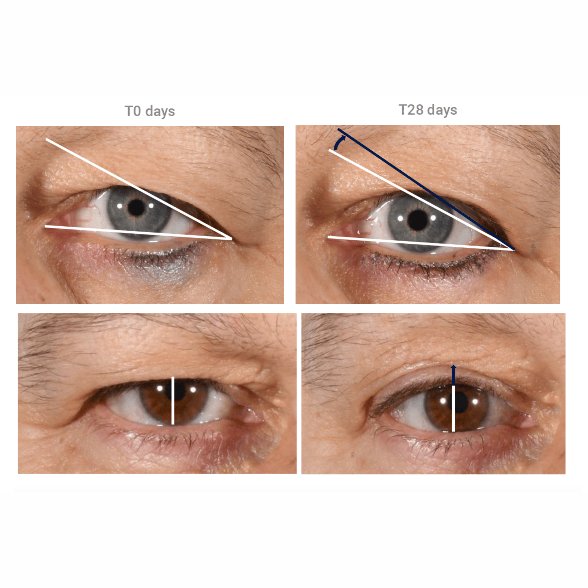 non-surgical EYELID LIFT