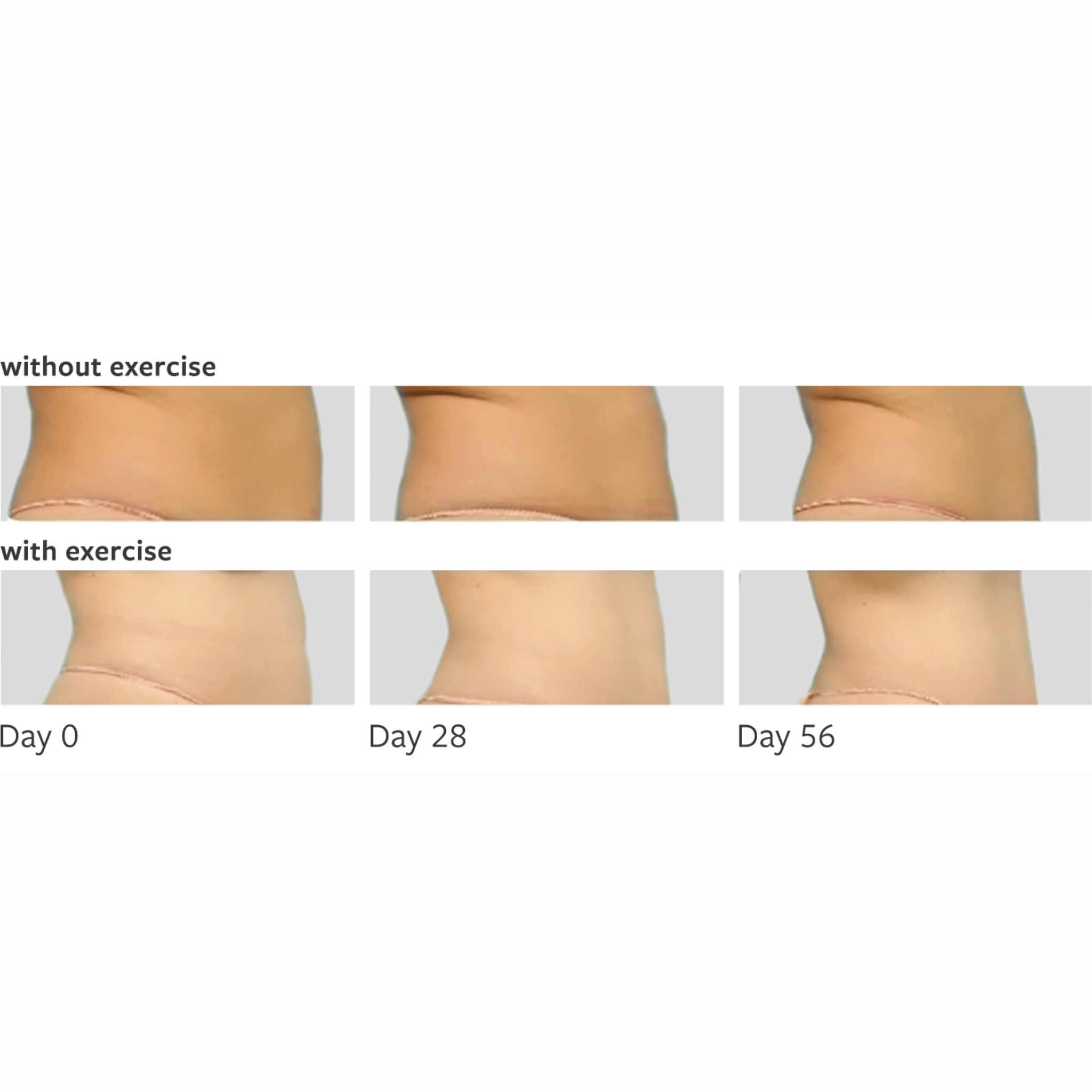 TUMMY TUCK