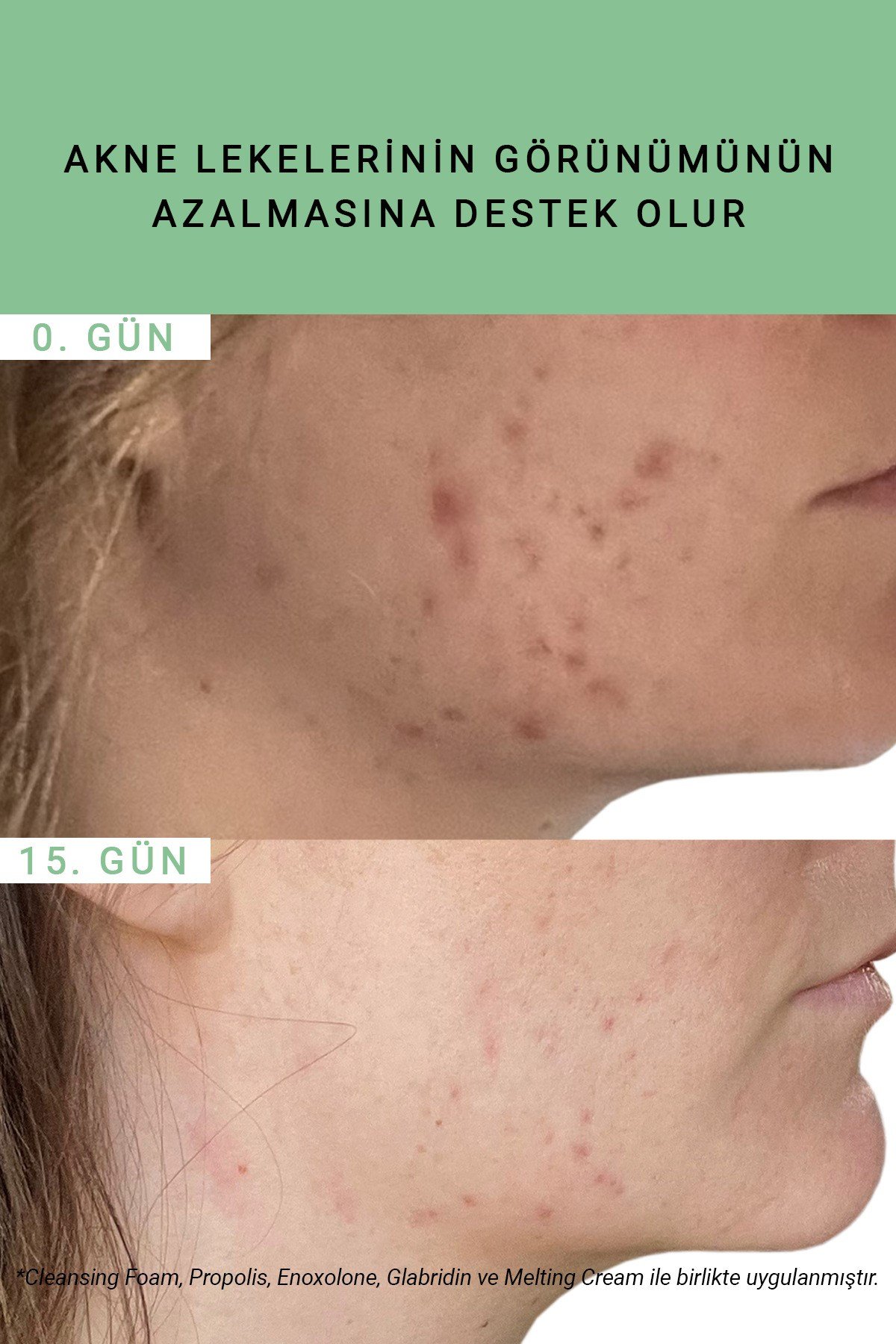 Pure Active Propolis Akne Karşıtı Antienflamatuar & Yatıştırıcı Etkili Konsantre Bakım Serumu 15ML