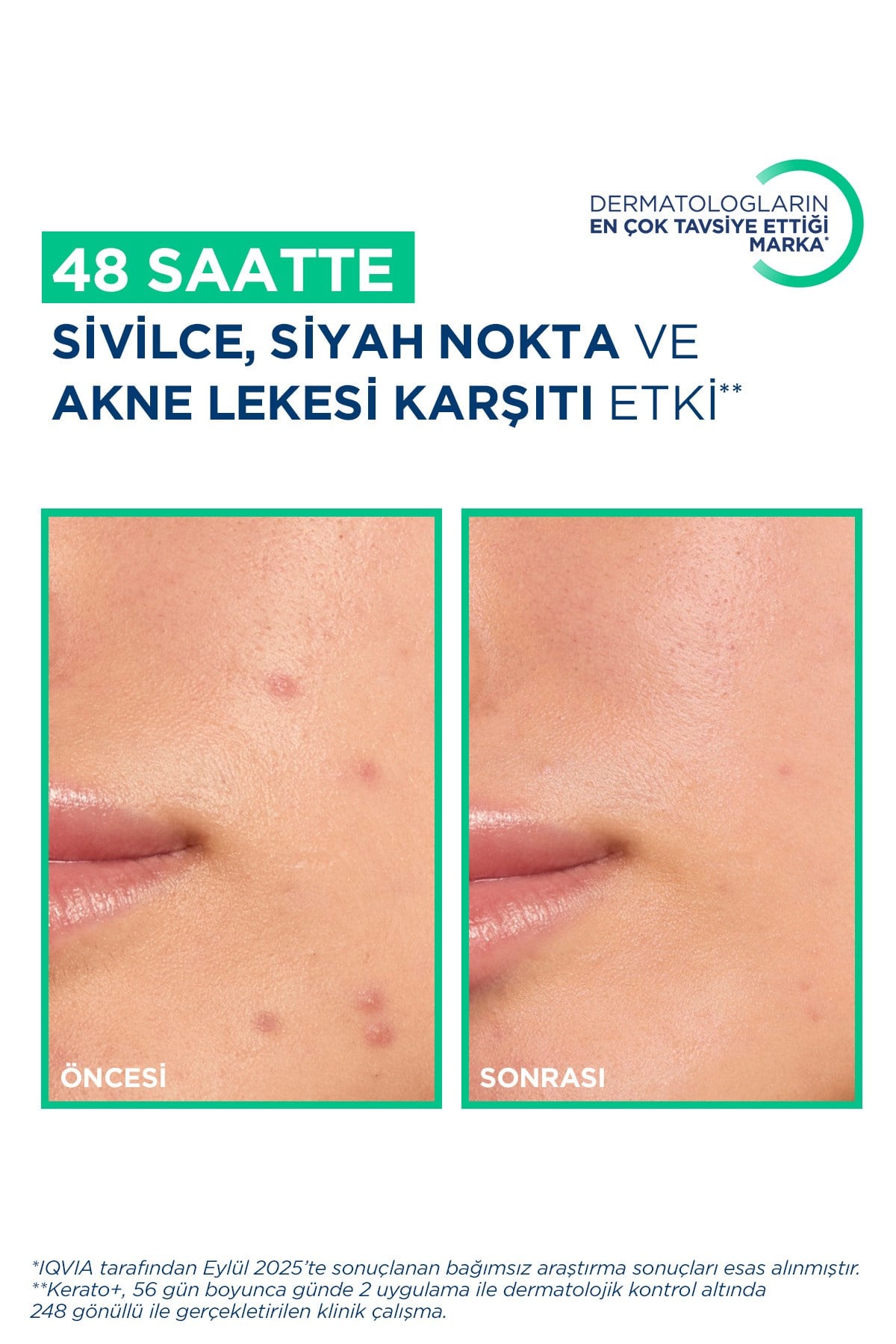 Sebium Kerato+ Salisilik Asit İçeren Sivilce Akne Lekesi Siyah Nokta Karşıtı Nemlendirici Krem 30ml