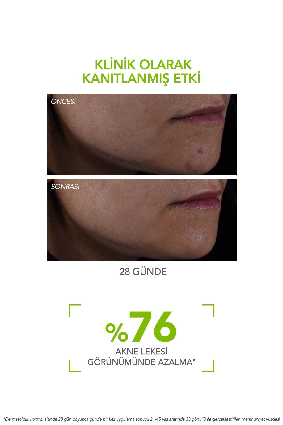 Sebium Serum Salisilik ve Hyaluronik Asit içeren Akne ve Leke Karşıtı Serum 30 ML