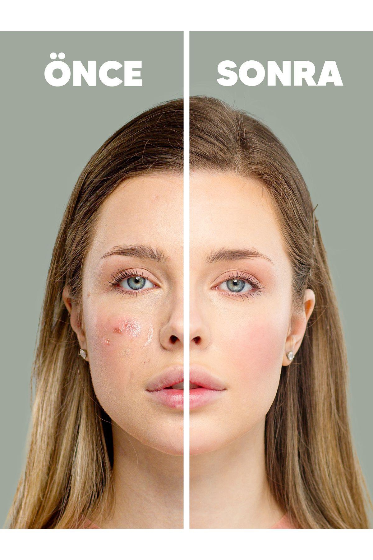 ZedermaZederma Akne Karşıtı Serum 30 mlZederma Akne Karşıtı Serum 30 ml Fiyatı ve Özellikleri | Mutlufiyatlar