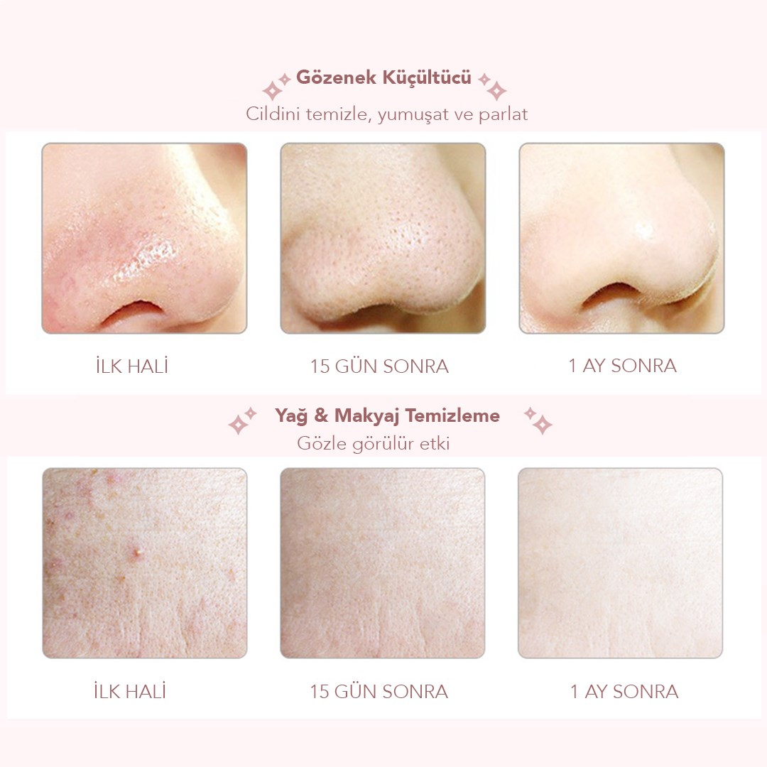 Ultrasonik Yüz Temizleme ve Peeling Cihazı 4 Modlu Derin Bakım Sistemi