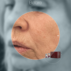 MORPHIYA – Exomorphic Biotech™ Dermal Hybrid Eksozom Kit (Cilt)