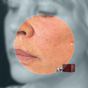 MORPHIYA – Exomorphic Biotech™ Dermal Hybrid Eksozom Kit (Cilt)