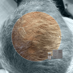 MORPHIYA – Exomorphic Biotech™ Scalp Hybrid Eksozom (Saç ve Saç Derisi)