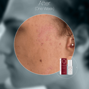 MORPHIYA - Exomorphic Biotech™ SOS Eksozom Kremi