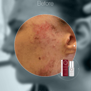 MORPHIYA - Exomorphic Biotech™ SOS Eksozom Kremi