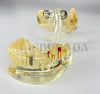 Diamonds Şeffaf İmplant Model Diş