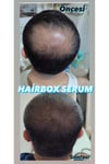 Erkek Saç Çıkarıcı Serum, Saç Çıkaran Serum , Saç Gürleştirici ( 5'li Set )