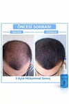 Erkek Saç Serumu, Saç Serumu , Saç Gürleştirici (5 Adet Serum )